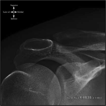 Zanca View Shoulder Xray