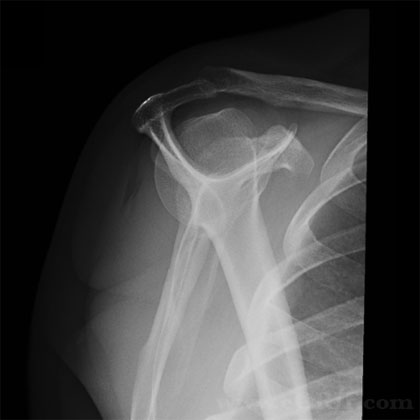 Scapular Y Shoulder Xray