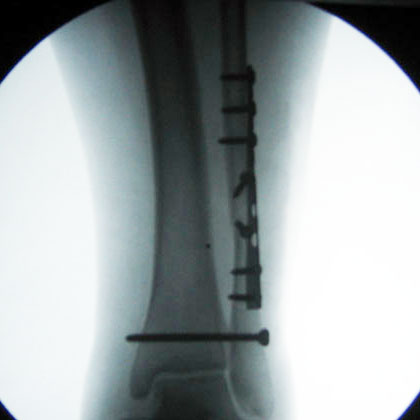 Lateral Malleolus fracture ORIF xray operative fixation