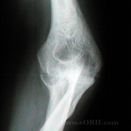 Elbow osteoarthritis xray