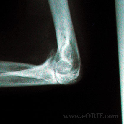 elbow arthritis lateral view