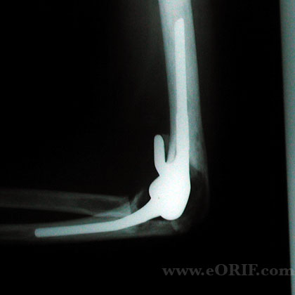 total elbow arthroplasty xray