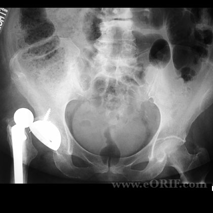 Total hip arthroplasty dislocation xray