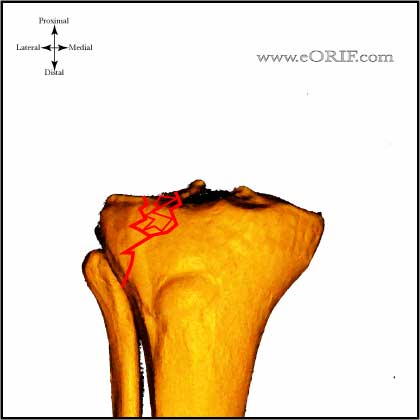 Type II Tibial Plateau Fracture image