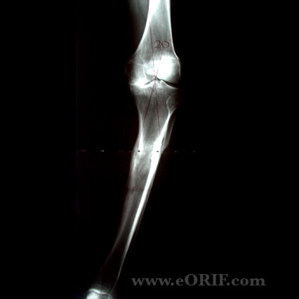 Tibial Shaft Fracture Malunion