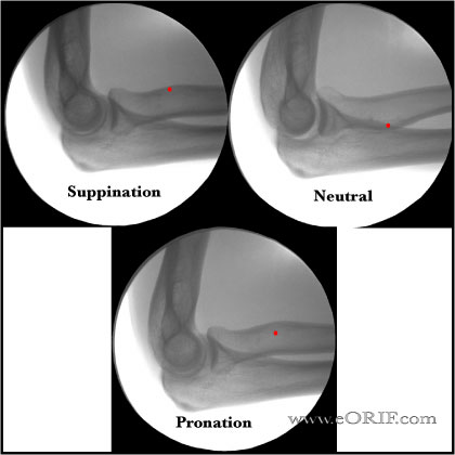 Lateral Elbow Xray