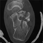 Calcaneus fracture CT scan image
