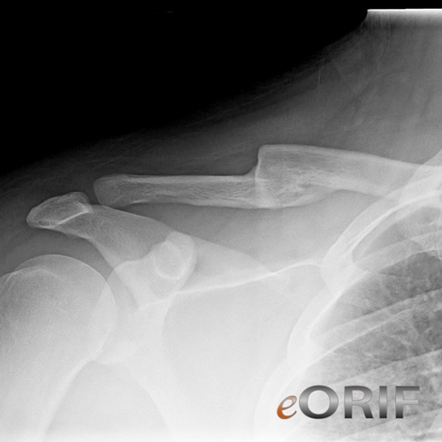 clavicle fracture malunion