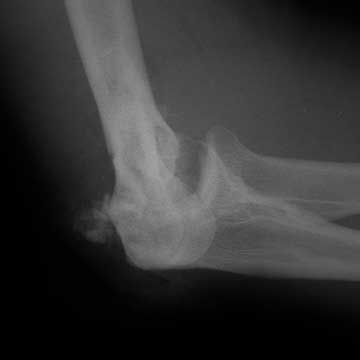 distal humerus fracture