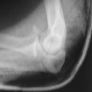 elbow dislocation xray
