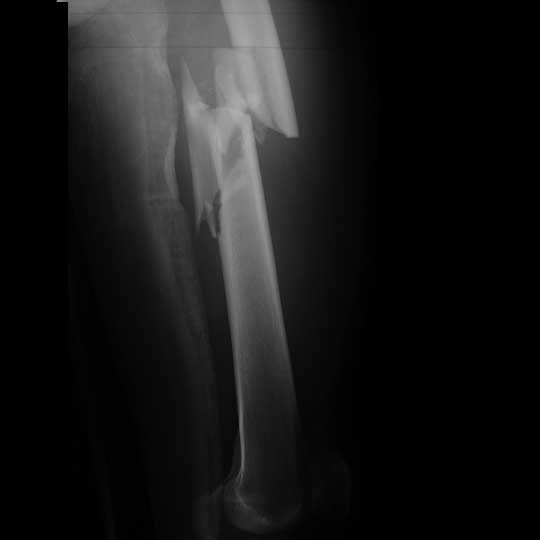 Femoral shaft fracture xray
