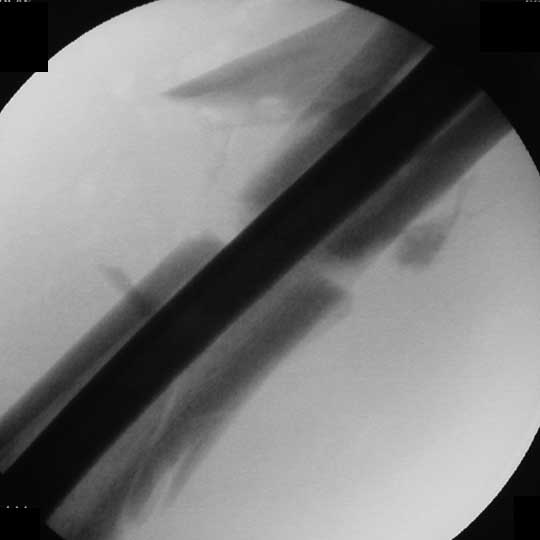 Femoral shaft fracture IM nail xray
