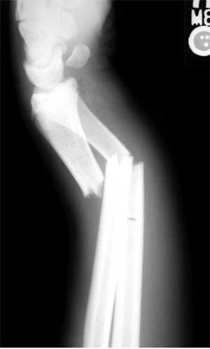 forearm fracture xray