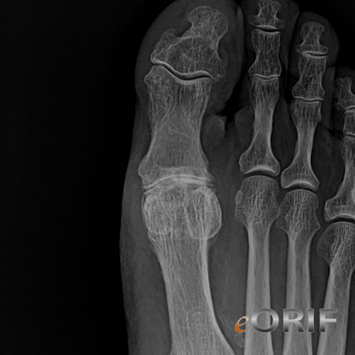 osteoarthritis metatarsophalangeal joint icd 10)