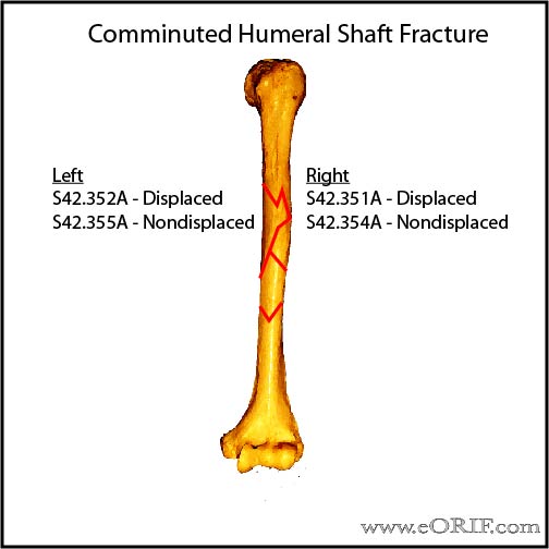 Comminuted humeral shaft fracture ICD-10 classification