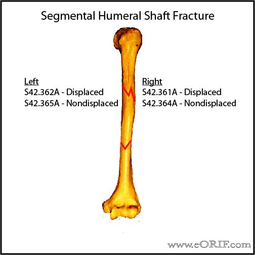 initial encounter for closed fracture meaning