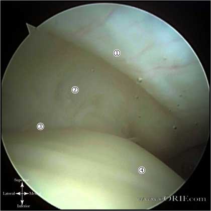 Rotator Cuff Cable image
