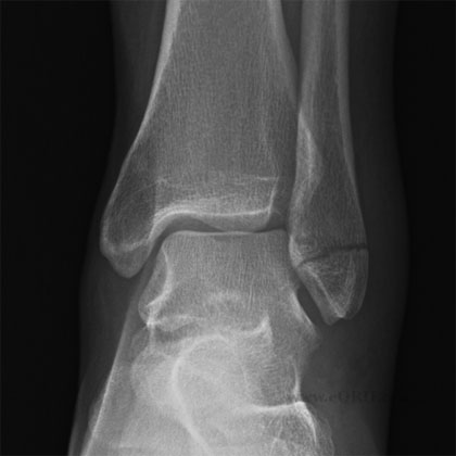 Lateral malleolus fracture xray