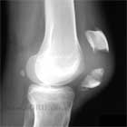 Displaced patella fracture lateral view xray