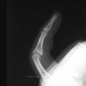 PIP fracture xray