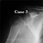 Proximal humerus fracture xray