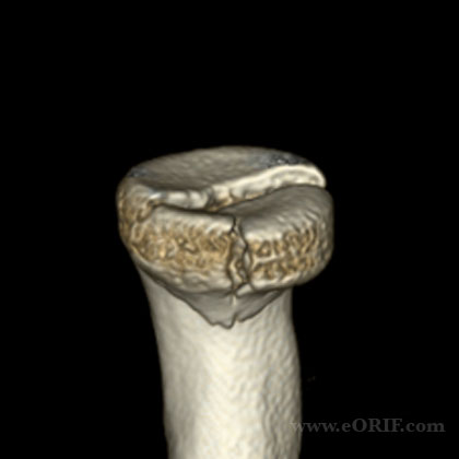 radial head fracture CT 3d reconstruction