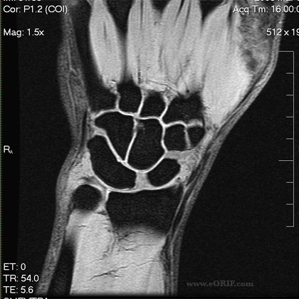Scapholunate instability MRI