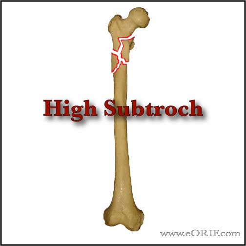 high subtroch femur fracture picture