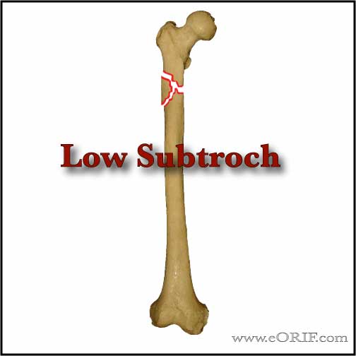 low subtract femur fracture picture