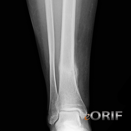 Tibial Shaft Stress Fracture Images | eORIF