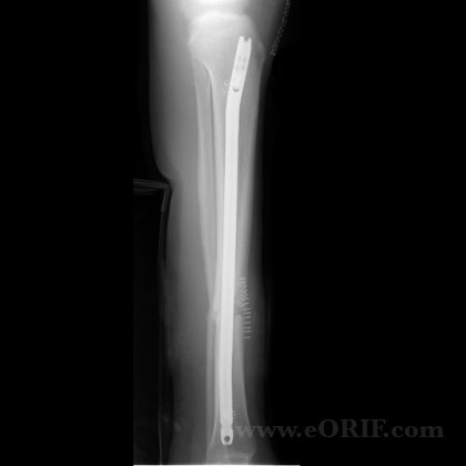 tibial shaft fracture nonunion im nail