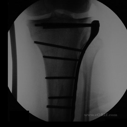 tibial plateau fracture xray