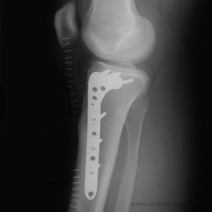tibial plateau fracture xray
