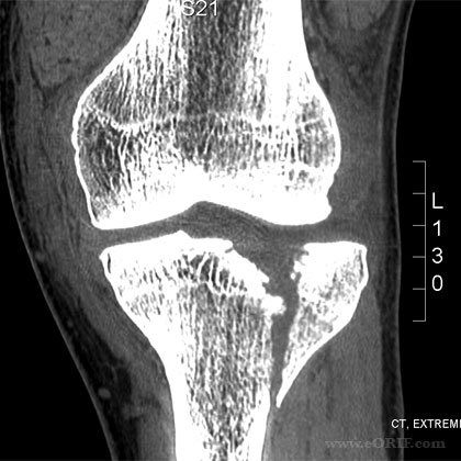 tibial plateau fracture Ct