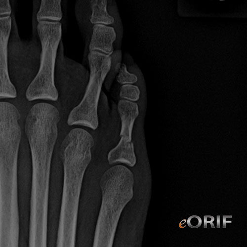 toe phalanx fracture
