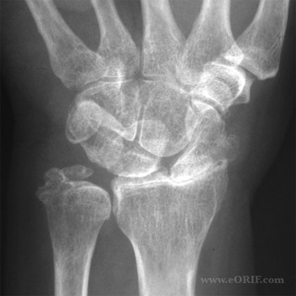Wrist Arthritis Images | eORIF